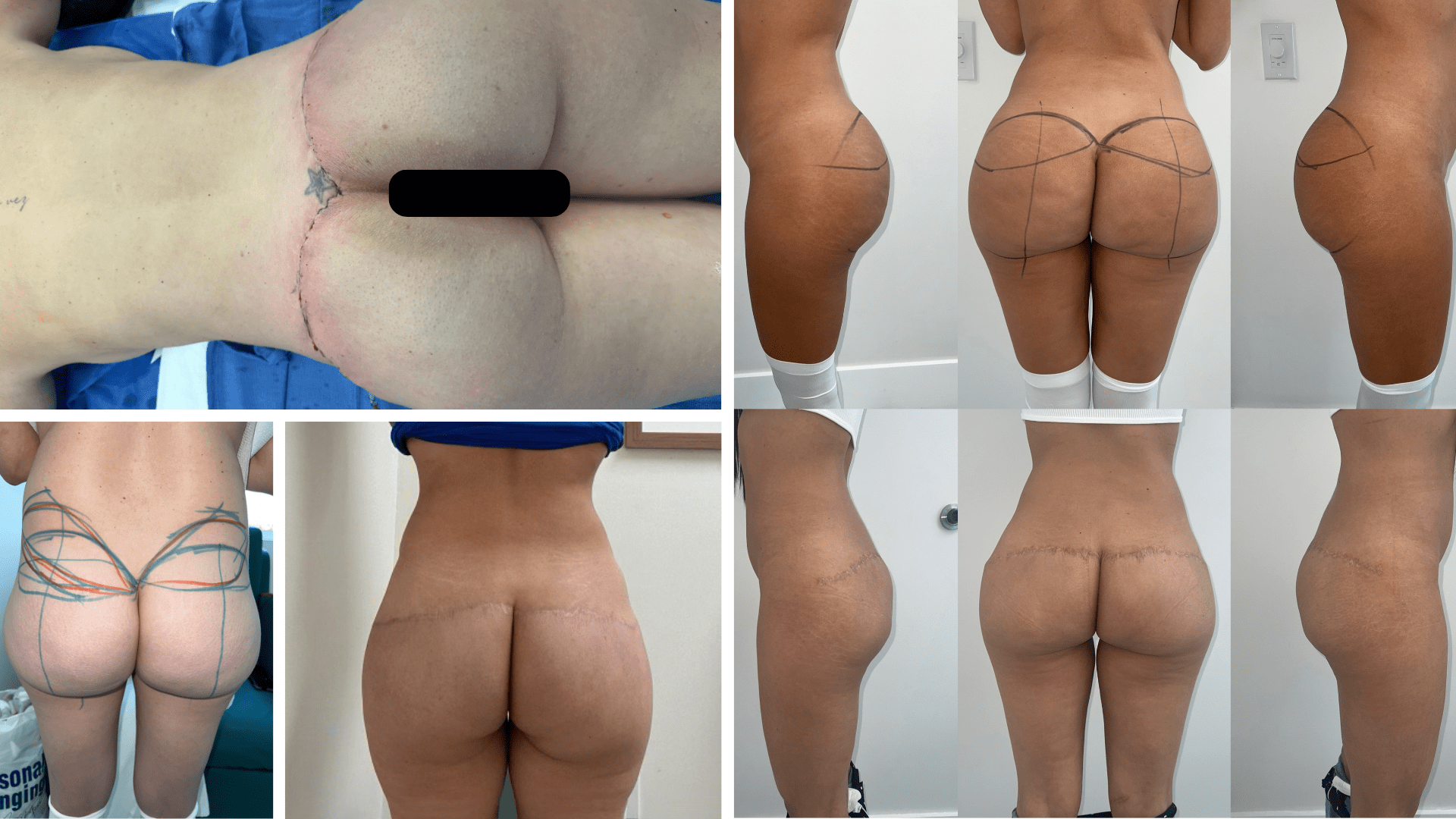 before and after biopolymer removal in Miami