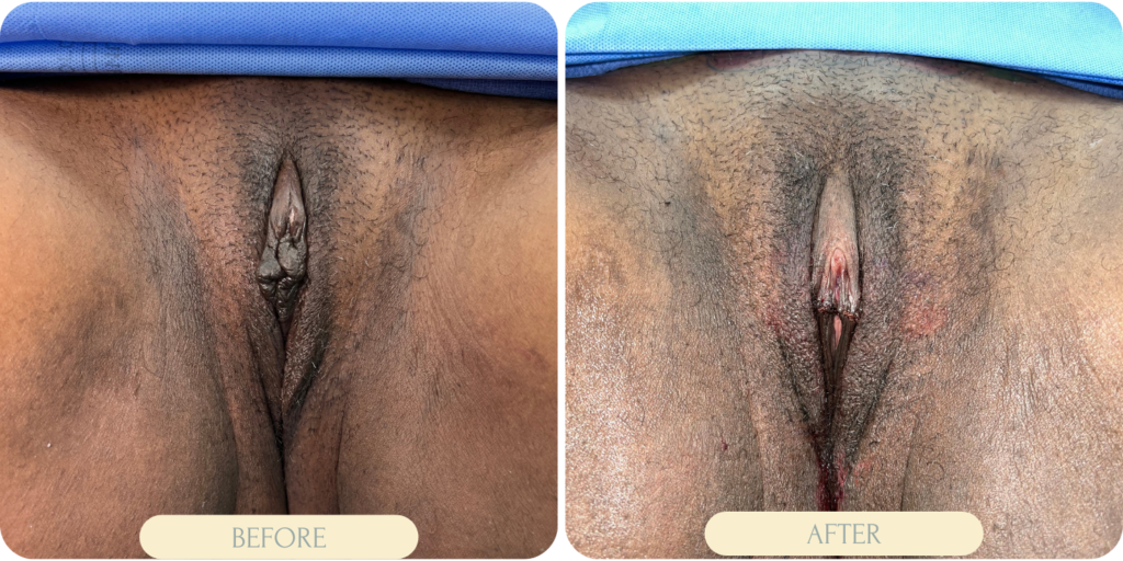 labiaplasty procedure in miami