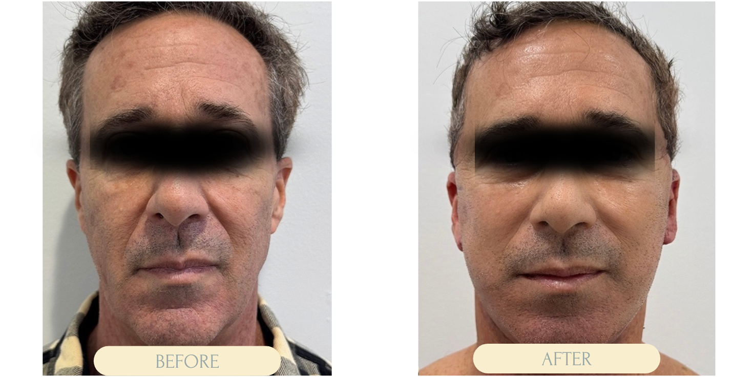 facelift south florida before after