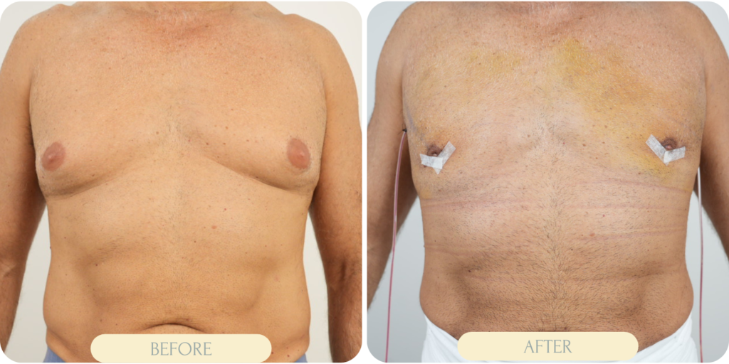 gynecomastia surgery in miami