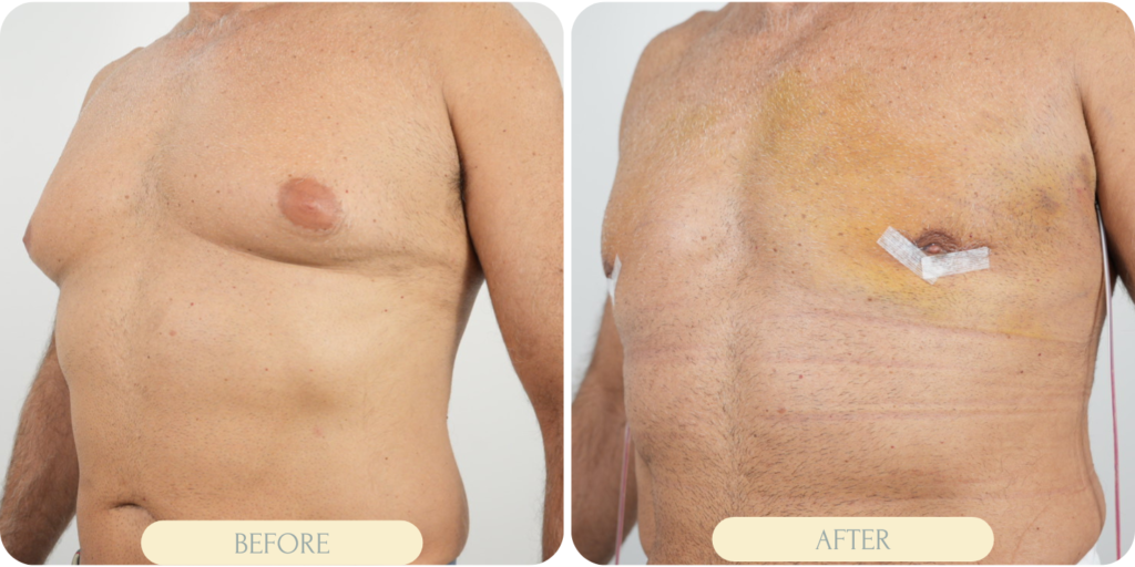 gynecomastia before and after miami