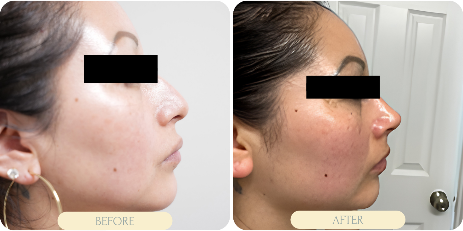 rhinoplasty miami before after