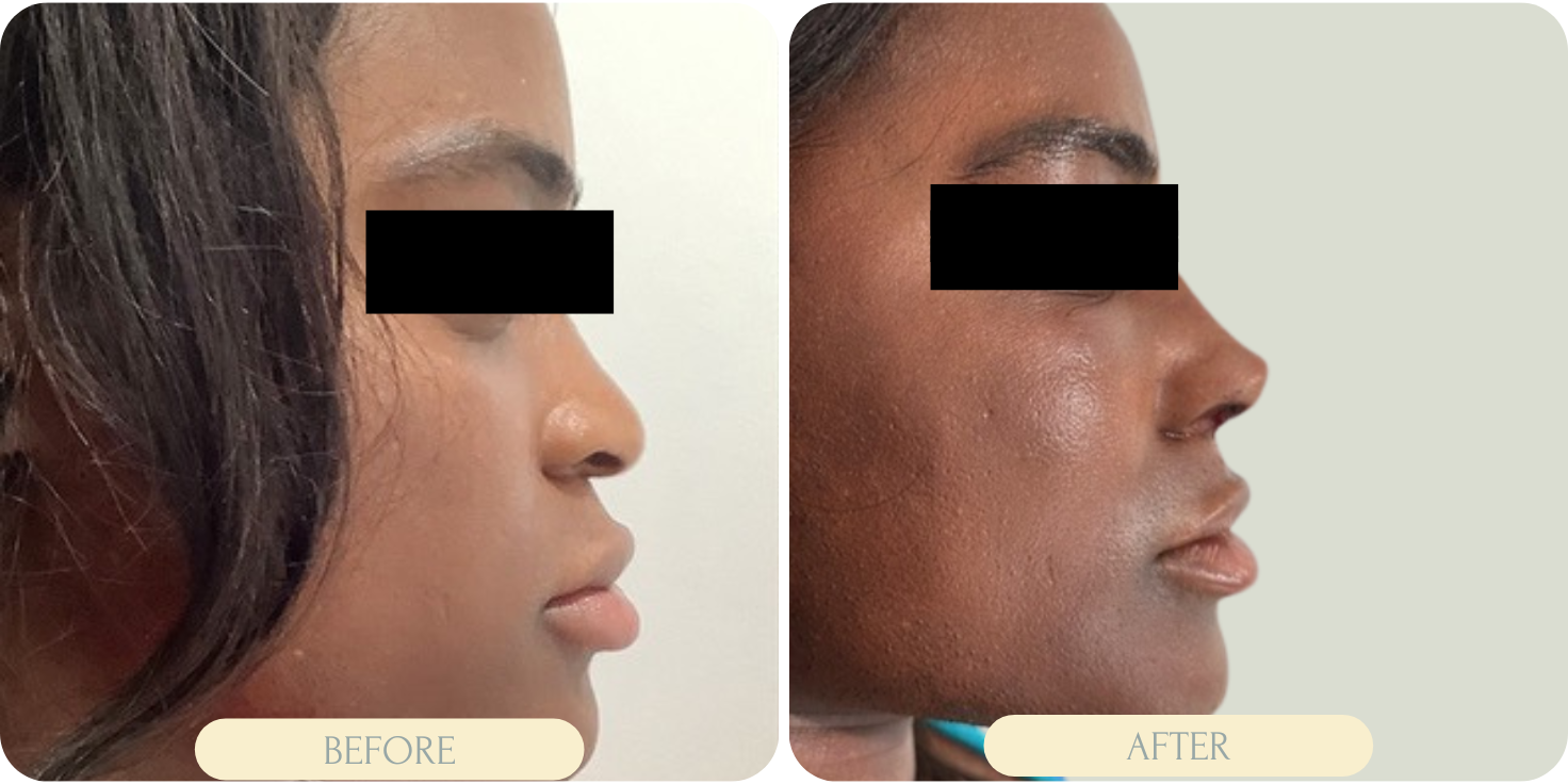 rhinoplasty procedure miami before after