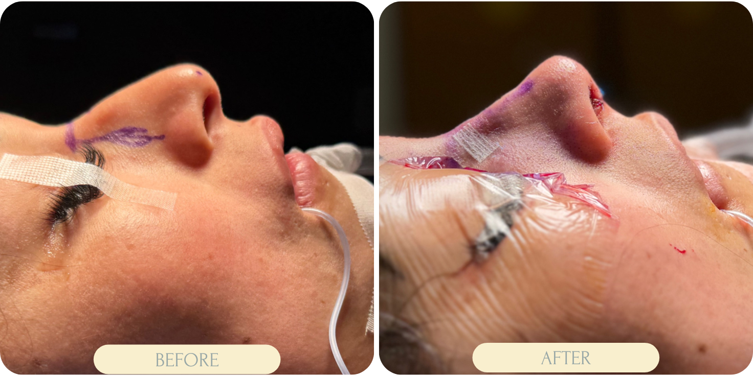 rhinoplasty surgery miami before after